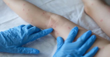 Parnaíba notifica dois casos suspeitos de varíola dos macacos
