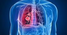 Câncer de pulmão é o que mais mata no Brasil e no mundo
